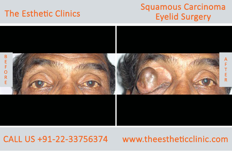 Sebaceous Carcinoma of Eyelid Surgery before after photos in mumbai india (1)